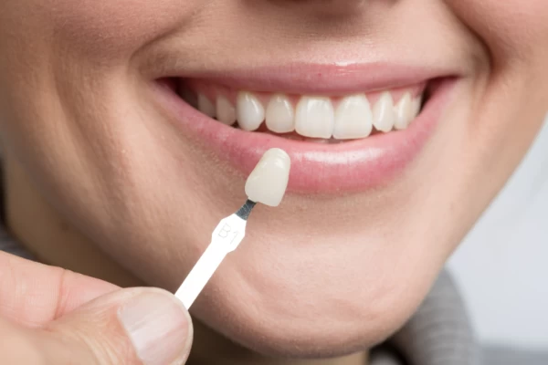 Bonding vs. Dental Veneers